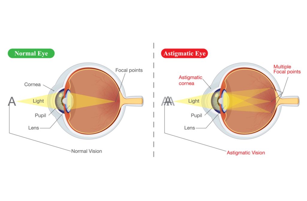 Illustration of normal eye on the left and astigmatic eye on the right