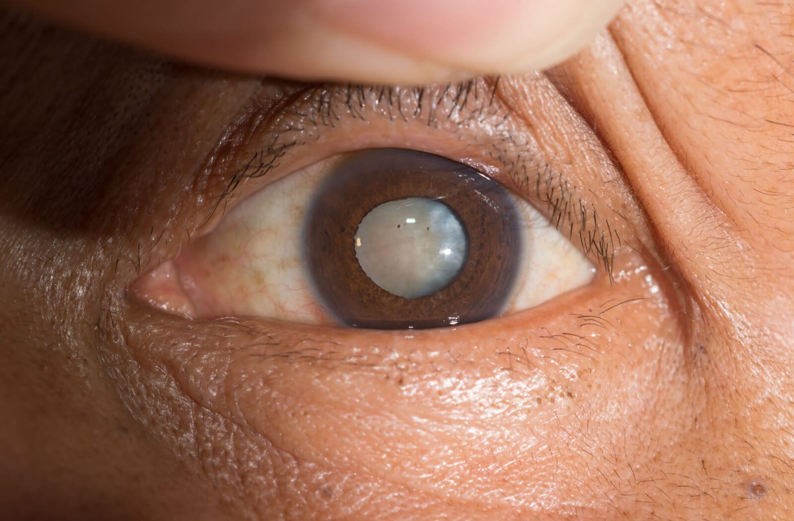 An intense close-up of an eye with cataracts.